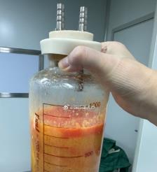 大同水动力吸脂手术要做多久？